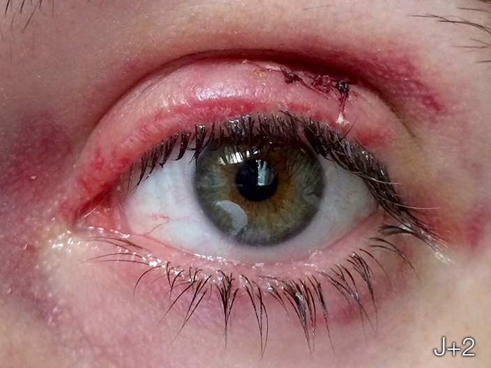 Chalazion surgery step 4